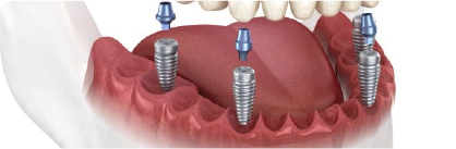 Implantes convencionais