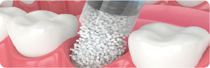 Implantes convencionais